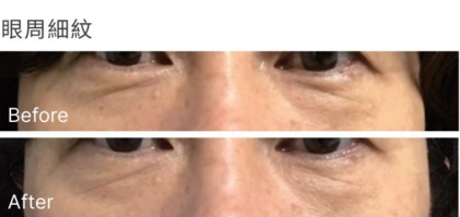 LIFTERA立特拉音波-1