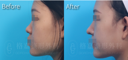 隆鼻2404