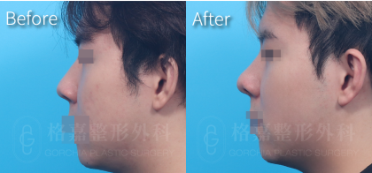 隆鼻2425