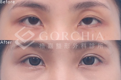 提眼肌手術-5
