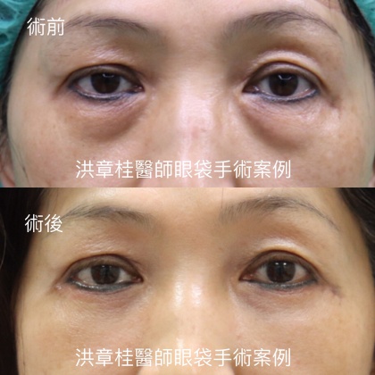 眼袋手術-2
