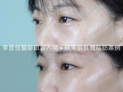 眼袋手術-8