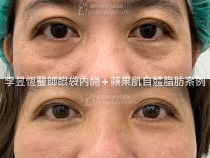 眼袋手術-9