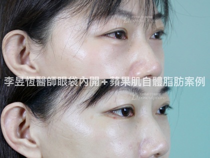 眼袋手術-10