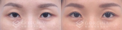 縫雙眼皮手術-1