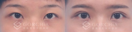 縫雙眼皮手術-4