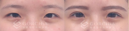 縫雙眼皮手術-8