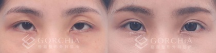 縫雙眼皮手術-9