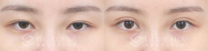 縫雙眼皮手術-10