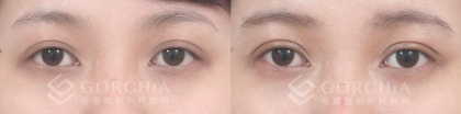 縫雙眼皮手術-11
