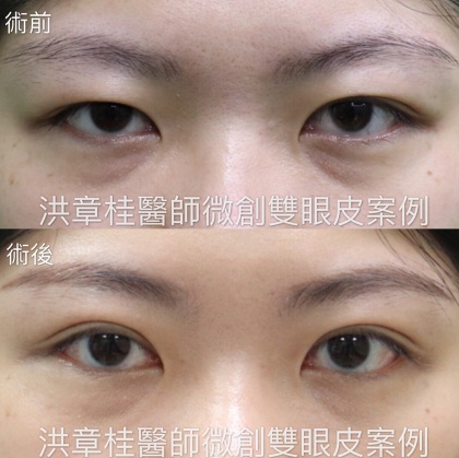縫雙眼皮手術-29