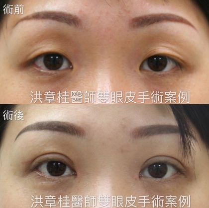 縫雙眼皮手術-31