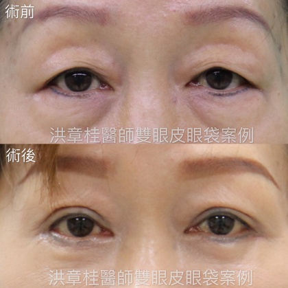 縫雙眼皮手術-32