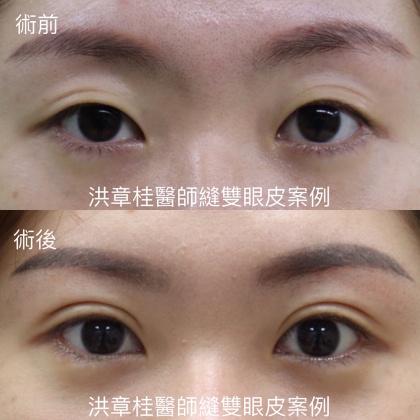 縫雙眼皮手術-34