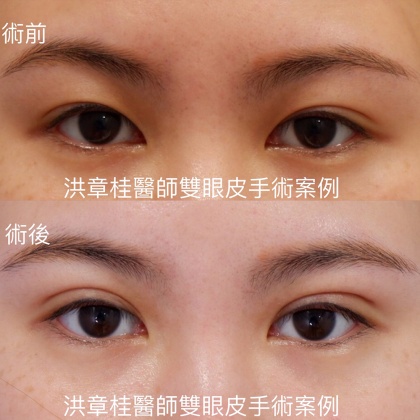 縫雙眼皮手術-35