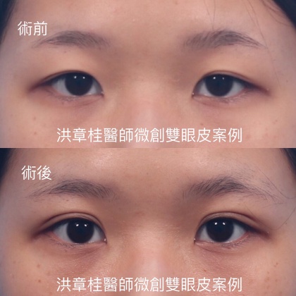 縫雙眼皮手術-36