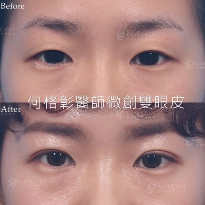 縫雙眼皮手術-38