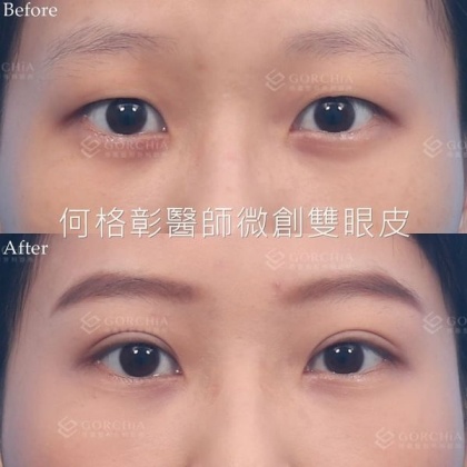 縫雙眼皮手術-39