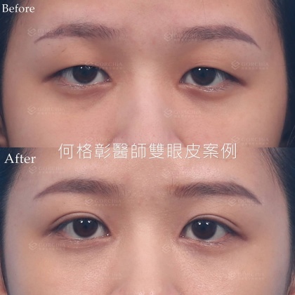 縫雙眼皮手術-42