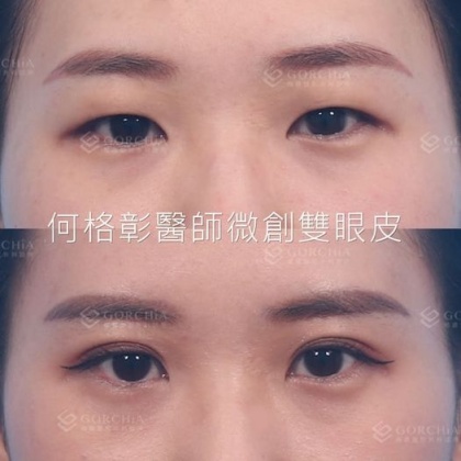 縫雙眼皮手術-44