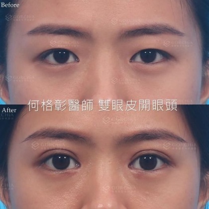 縫雙眼皮手術-45