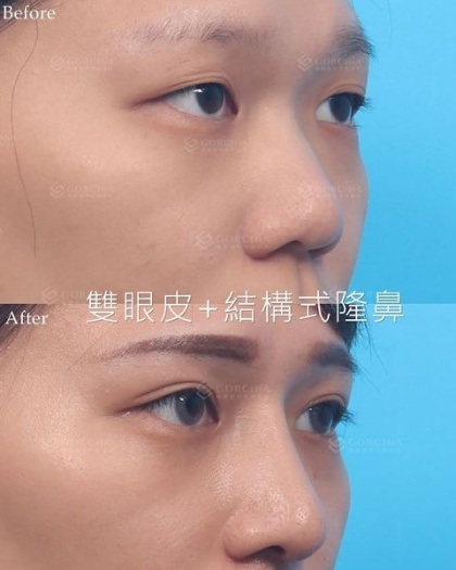 縫雙眼皮手術-46