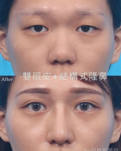 縫雙眼皮手術-47