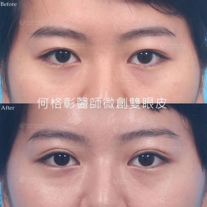 縫雙眼皮手術-48