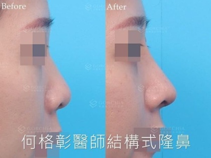 結構式隆鼻-25