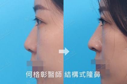 結構式隆鼻-38