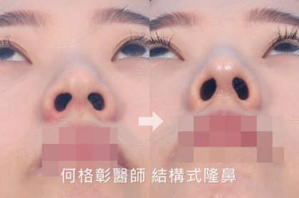 結構式隆鼻-39