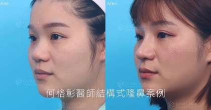 結構式隆鼻-80