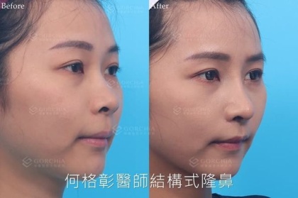 結構式隆鼻-84