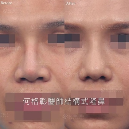 結構式隆鼻-85