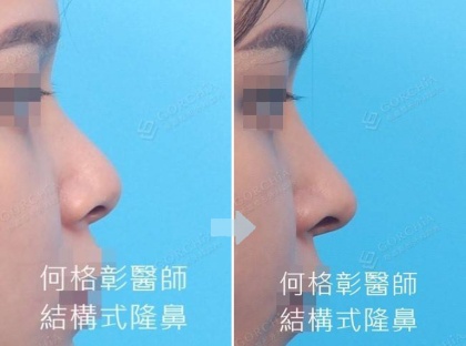 結構式隆鼻-96