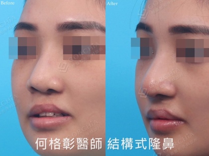 結構式隆鼻-101