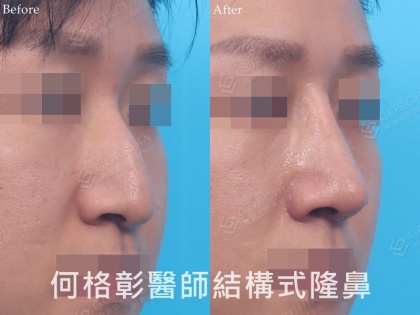 結構式隆鼻-103