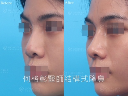 結構式隆鼻-106
