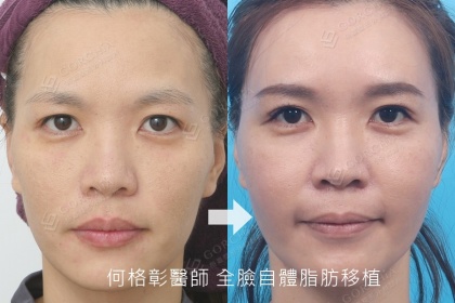 自體脂肪補脂手術-3