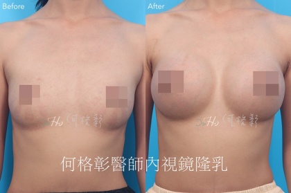 內視鏡隆乳-1