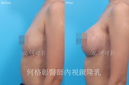 內視鏡隆乳-3