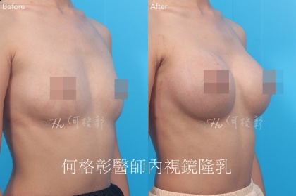 內視鏡隆乳-4
