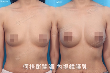 內視鏡隆乳-7