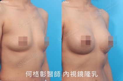 內視鏡隆乳-8