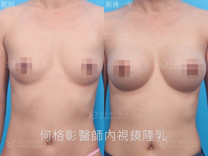 內視鏡隆乳-9