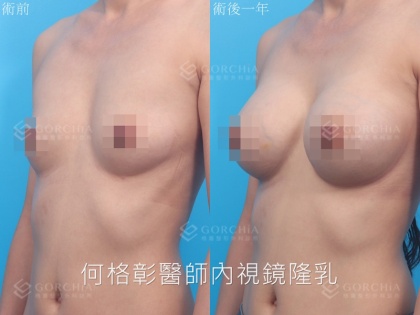內視鏡隆乳-10