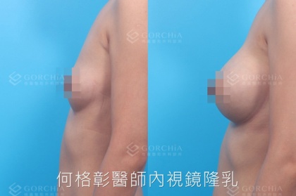 內視鏡隆乳-11