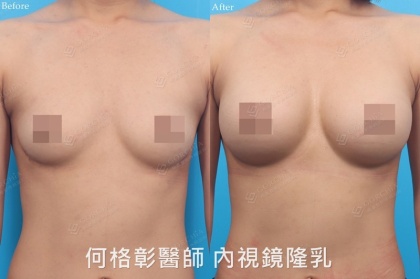 內視鏡隆乳-12