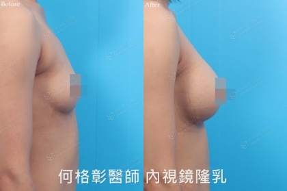 內視鏡隆乳-14
