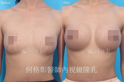 內視鏡隆乳-15